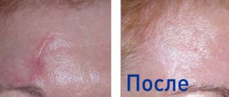 фото до и после процедуры лазерной шлифовки шрамов
