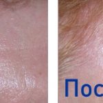 фото до и после процедуры лазерной шлифовки шрамов