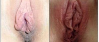 Гипертрофия малых половых губ