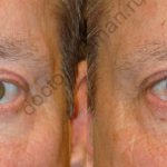 Исправление асимметрии в области глаз с помощью пластической хирургии. Результат до и после