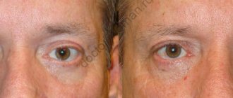Исправление асимметрии в области глаз с помощью пластической хирургии. Результат до и после