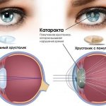 Как видит глаз с катарактой
