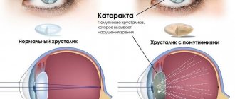How does an eye with a cataract see?