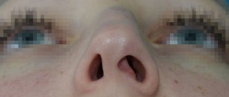 Кривой нос