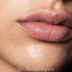 Липофилинг губ в клиники Гришкяна в москве