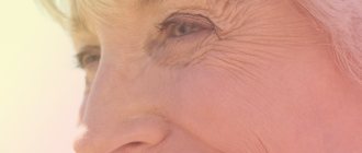 Causes of wrinkles under the eyes