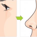 ринопластика длинного носа