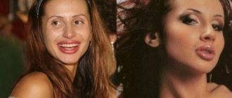 Svetlana Loboda before and after plastic surgery