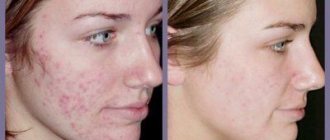 Removal of scars and acne scars before and after photos